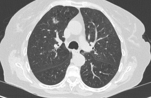 Lung CT
